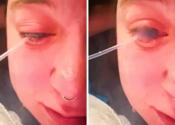 Paltar yuyarkən gözlərinə ağartıcı sıçradı – Bir gözü kor oldu