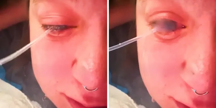 Paltar yuyarkən gözlərinə ağartıcı sıçradı - Bir gözü kor oldu